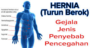 Illustration for article titled Obat Hernia Anak Di Apotik